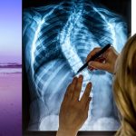 From Curves to Calm: How Yoga Heals the Scoliosis Spine